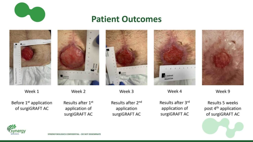 The Role of SurgiGRAFT AC in Treating Incisional Dehiscence Following Abdominal Surgery
